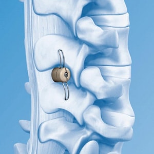implanty kręgosłupa, schorzenia kręgosłupa, ortopedia, leczenie kręgosłupa