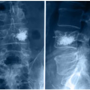 Wertebroplastyka w złamaniach osteoporotycznych kręgosłupa, cementoplastyka